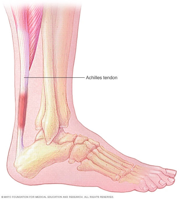 Achilles tendonitis and hiking trailside fitness