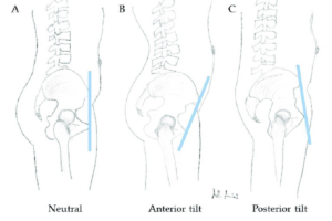 hip pain