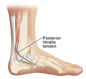 posterior tibialis tendonitis trailside fitness